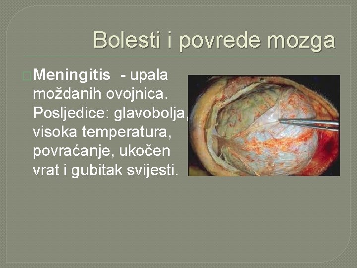 Bolesti i povrede mozga �Meningitis - upala moždanih ovojnica. Posljedice: glavobolja, visoka temperatura, povraćanje,
