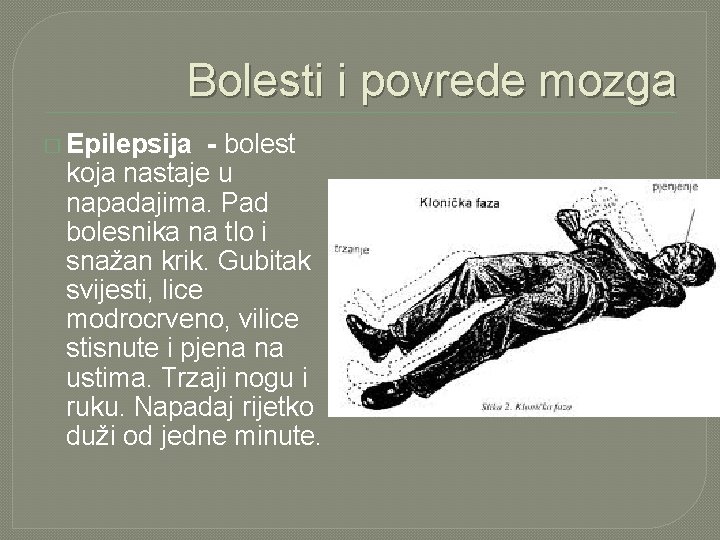 Bolesti i povrede mozga � Epilepsija - bolest koja nastaje u napadajima. Pad bolesnika