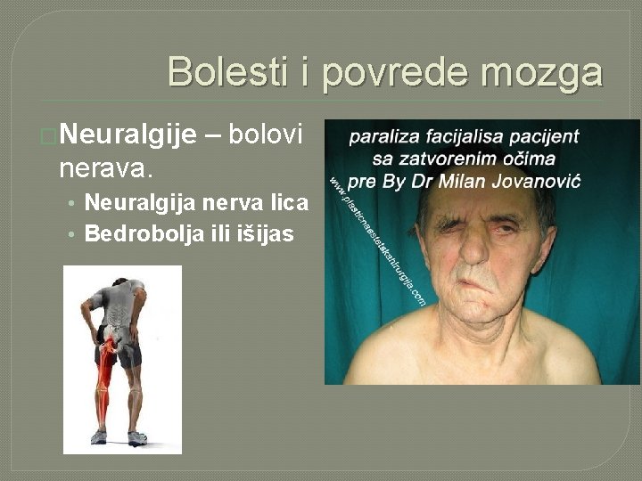 Bolesti i povrede mozga �Neuralgije – bolovi nerava. • Neuralgija nerva lica • Bedrobolja