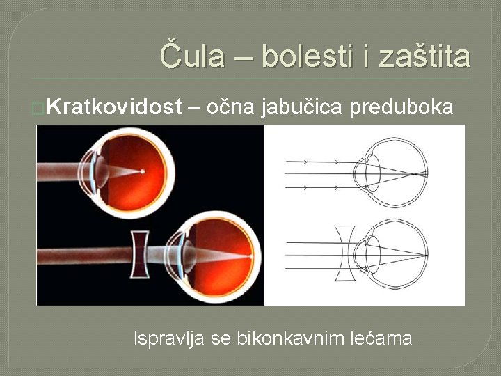 Čula – bolesti i zaštita �Kratkovidost – očna jabučica preduboka Ispravlja se bikonkavnim lećama