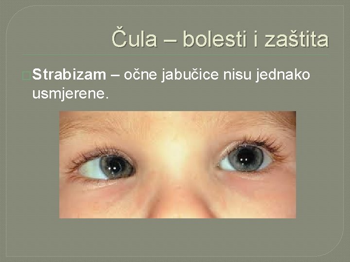 Čula – bolesti i zaštita �Strabizam usmjerene. – očne jabučice nisu jednako 