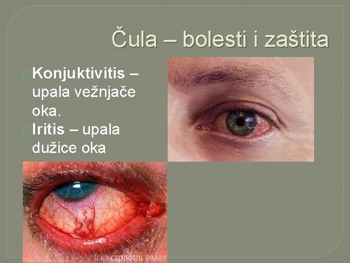 Čula – bolesti i zaštita �Konjuktivitis – upala vežnjače oka. �Iritis – upala dužice