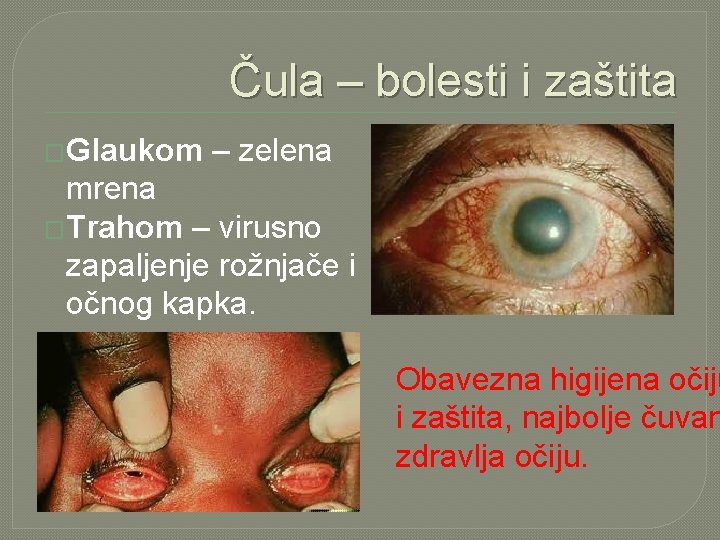 Čula – bolesti i zaštita �Glaukom – zelena mrena �Trahom – virusno zapaljenje rožnjače