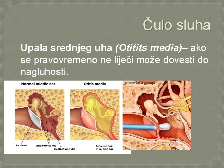 Čulo sluha �Upala srednjeg uha (Otitits media)– ako se pravovremeno ne liječi može dovesti