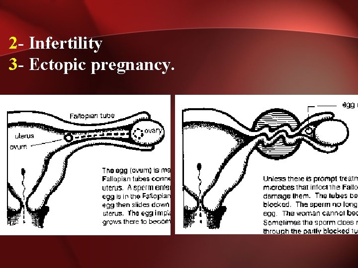 2 - Infertility 3 - Ectopic pregnancy. 