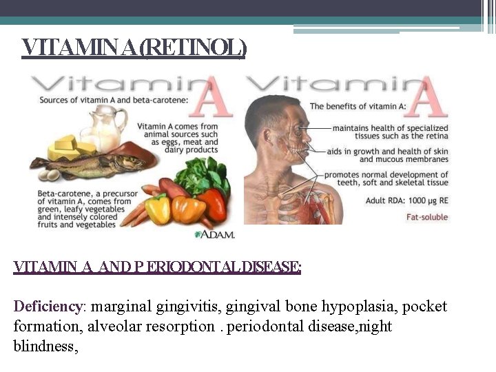 VITAMIN A(RETINOL) VITAMIN A AND P ERIODONTALDISEASE: Deficiency: marginal gingivitis, gingival bone hypoplasia, pocket