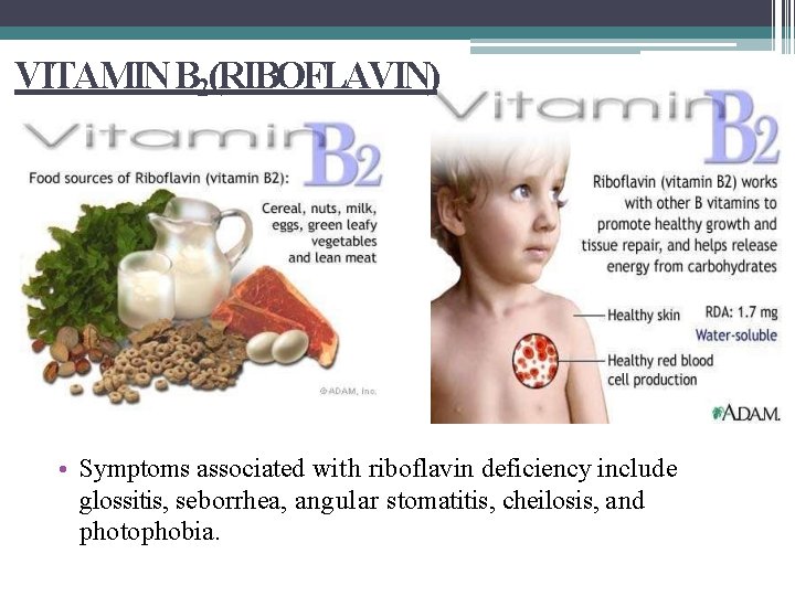 VITAMIN B 2(RIBOFLAVIN) • Symptoms associated with riboflavin deficiency include glossitis, seborrhea, angular stomatitis,