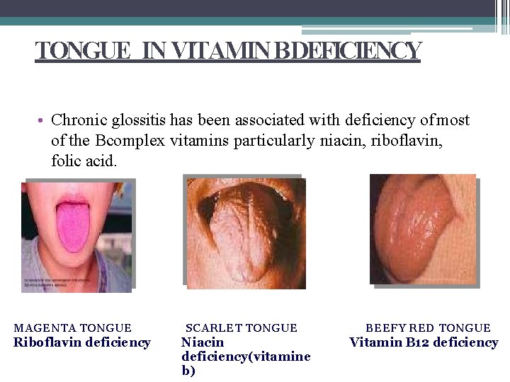 TONGUE IN VITAMIN B DEFICIENCY • Chronic glossitis has been associated with deficiency of