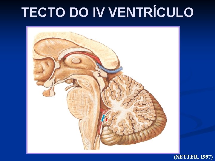 TECTO DO IV VENTRÍCULO (NETTER, 1997) 