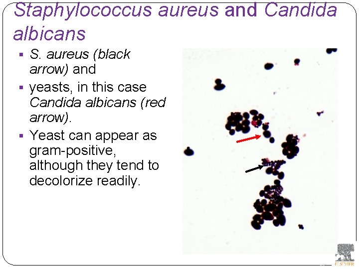 Staphylococcus aureus and Candida albicans § S. aureus (black arrow) and § yeasts, in