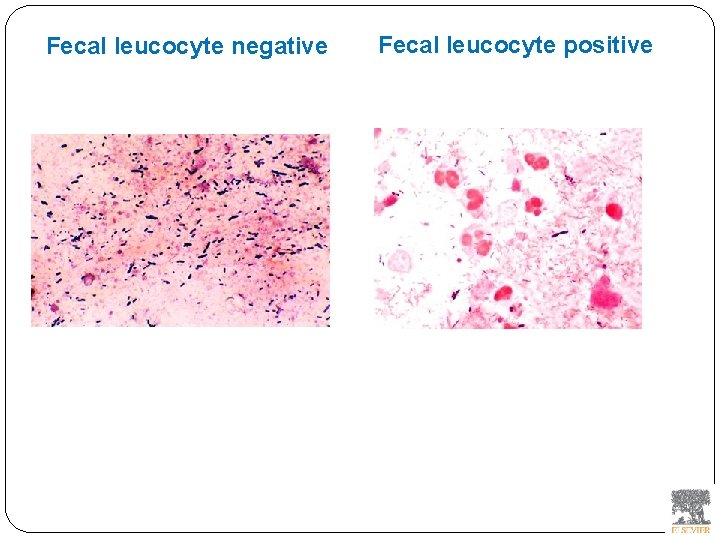 Fecal leucocyte negative Fecal leucocyte positive 