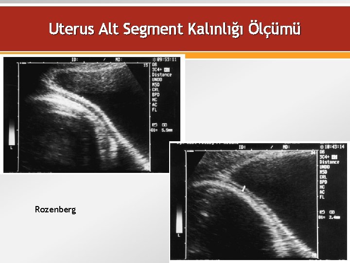 Uterus Alt Segment Kalınlığı Ölçümü Rozenberg 54 