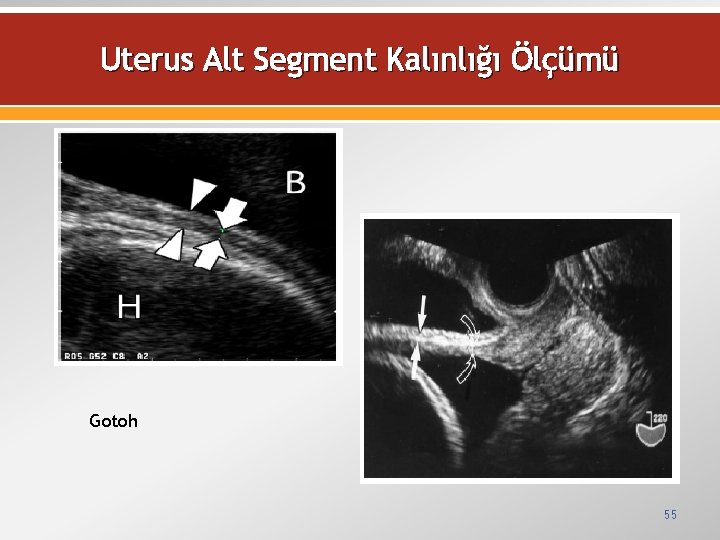 Uterus Alt Segment Kalınlığı Ölçümü Gotoh 55 