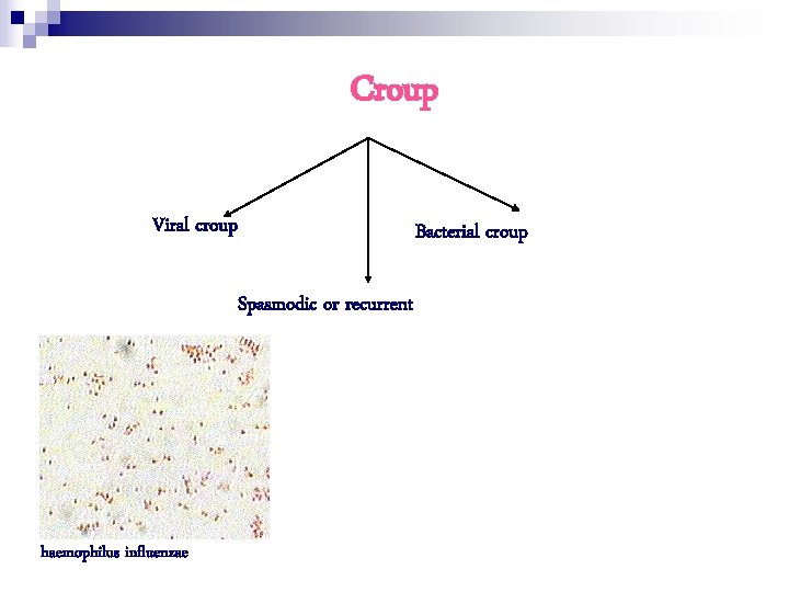 Croup Viral croup Bacterial croup Spasmodic or recurrent haemophilus influenzae 