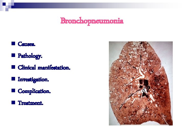 Bronchopneumonia n Causes. n Pathology. n Clinical manifestation. n Investigation. n Complication. n Treatment.