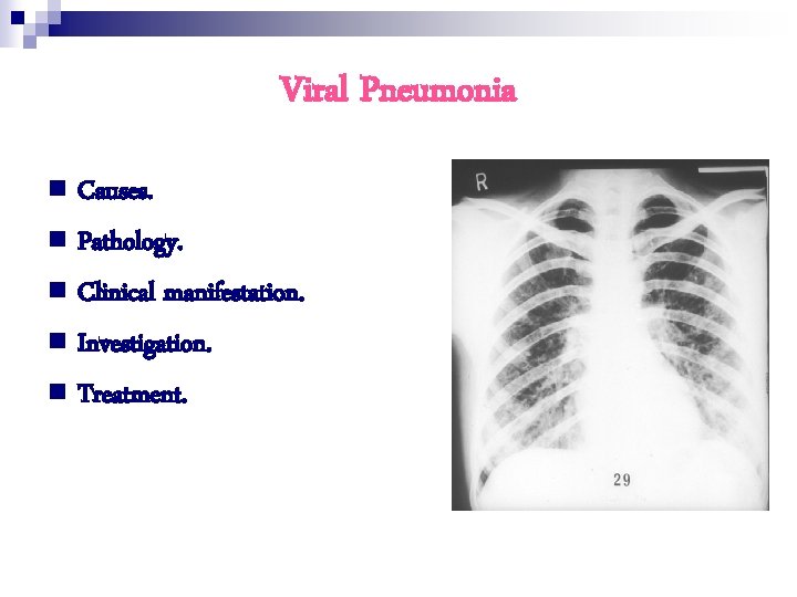Viral Pneumonia n Causes. n Pathology. n Clinical manifestation. n Investigation. n Treatment. 