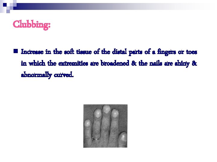 Clubbing: n Increase in the soft tissue of the distal parts of a fingers