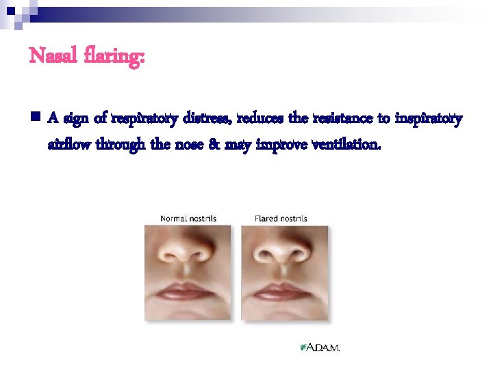 Nasal flaring: n A sign of respiratory distress, reduces the resistance to inspiratory airflow