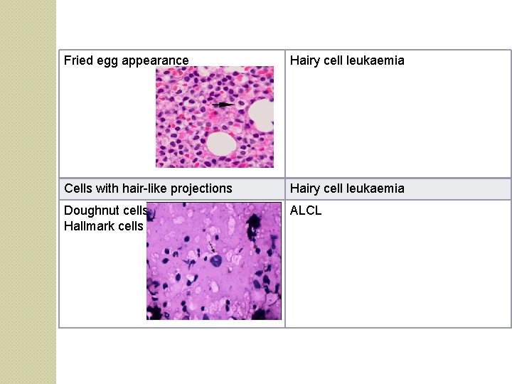 Fried egg appearance Hairy cell leukaemia Cells with hair-like projections Hairy cell leukaemia Doughnut