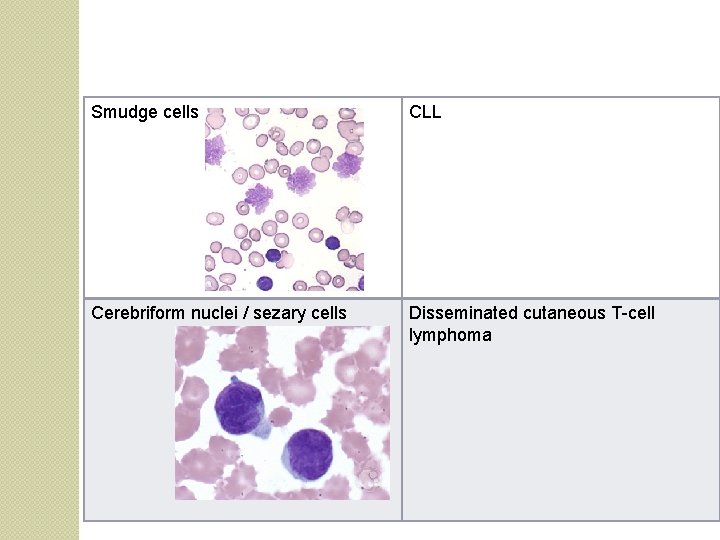 Smudge cells CLL Cerebriform nuclei / sezary cells Disseminated cutaneous T-cell lymphoma 