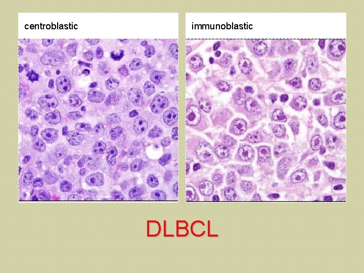 centroblastic immunoblastic DLBCL 