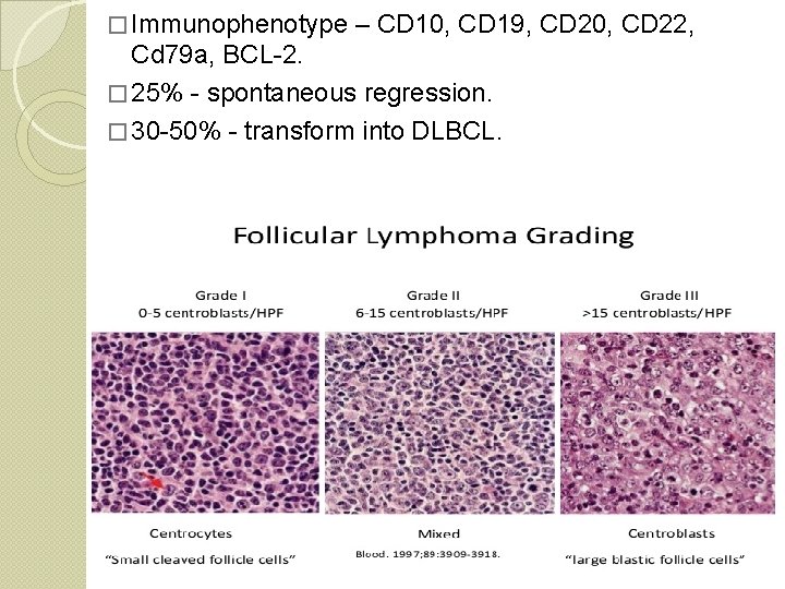 � Immunophenotype – CD 10, CD 19, CD 20, CD 22, Cd 79 a,