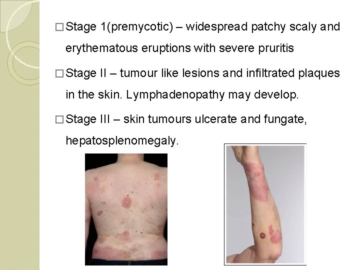 � Stage 1(premycotic) – widespread patchy scaly and erythematous eruptions with severe pruritis �