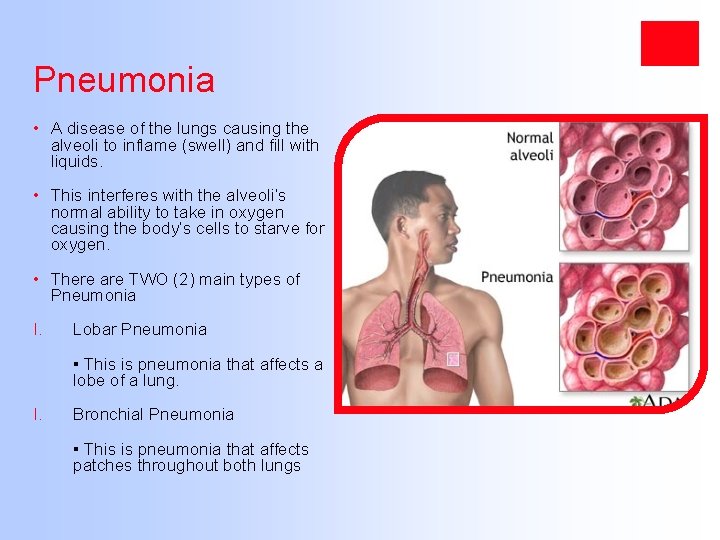 Pneumonia • A disease of the lungs causing the alveoli to inflame (swell) and