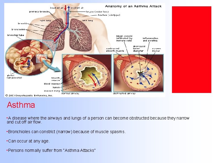 Asthma • A disease where the airways and lungs of a person can become