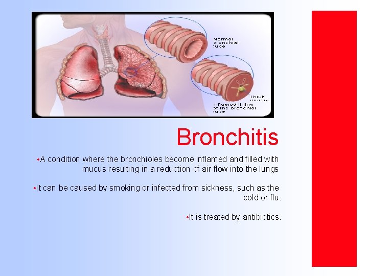 Bronchitis • A condition where the bronchioles become inflamed and filled with mucus resulting