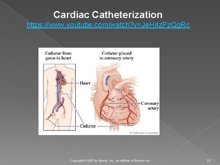 Cardiac Catheterization https: //www. youtube. com/watch? v=Je. H 4 z. Pz. Qg. Rc Copyright