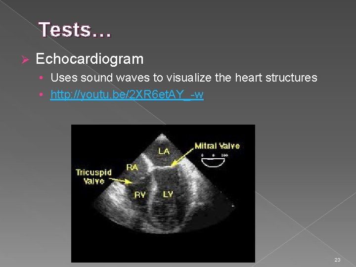 Tests… Ø Echocardiogram • Uses sound waves to visualize the heart structures • http: