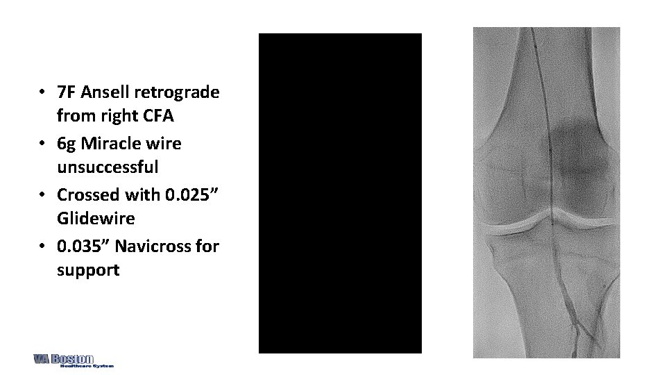  • 7 F Ansell retrograde from right CFA • 6 g Miracle wire