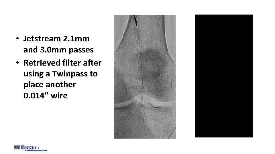  • Jetstream 2. 1 mm and 3. 0 mm passes • Retrieved filter