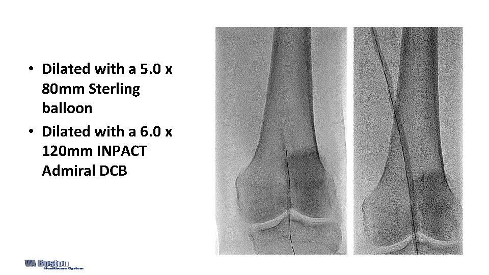  • Dilated with a 5. 0 x 80 mm Sterling balloon • Dilated
