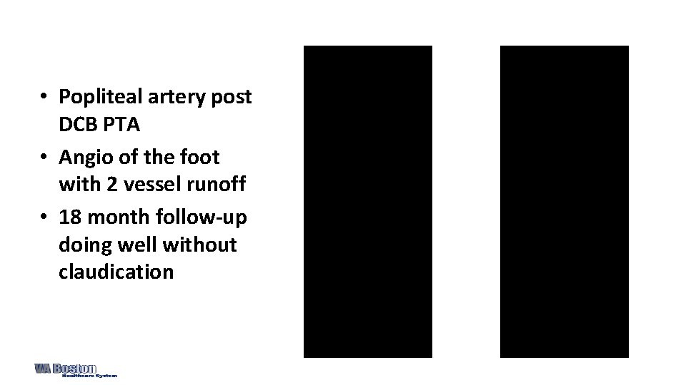  • Popliteal artery post DCB PTA • Angio of the foot with 2