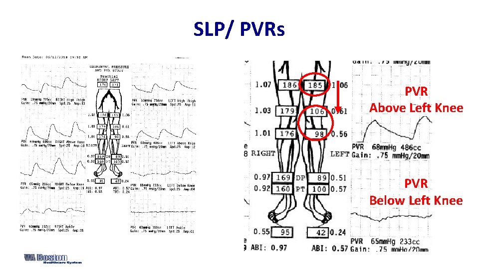 SLP/ PVRs PVR Above Left Knee PVR Below Left Knee 