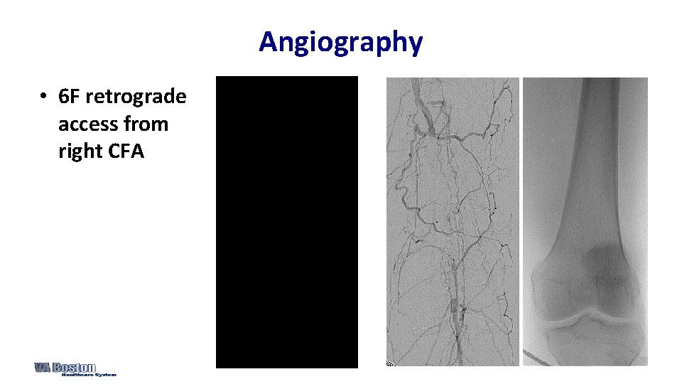 Angiography • 6 F retrograde access from right CFA 