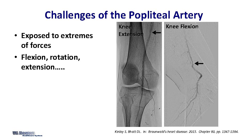 Challenges of the Popliteal Artery • Exposed to extremes of forces • Flexion, rotation,