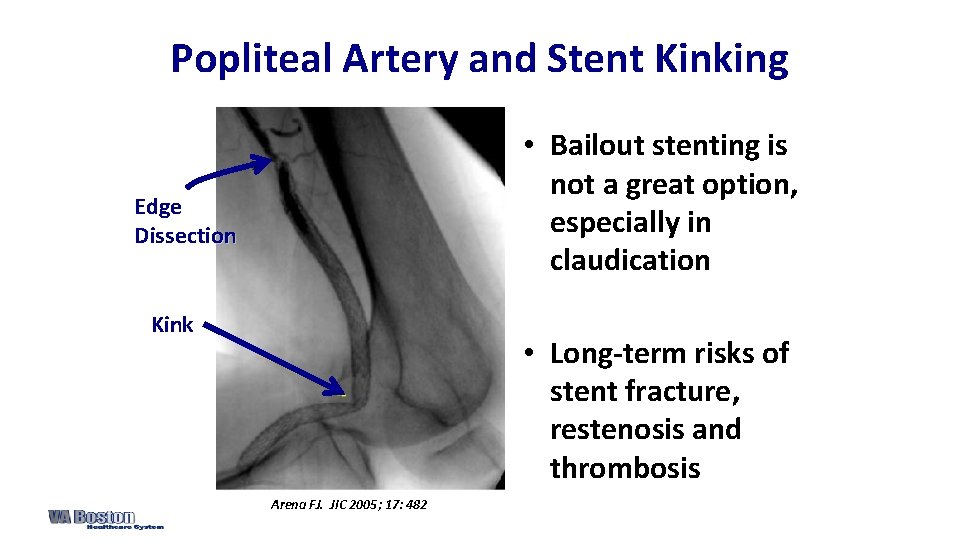 Popliteal Artery and Stent Kinking • Bailout stenting is not a great option, especially