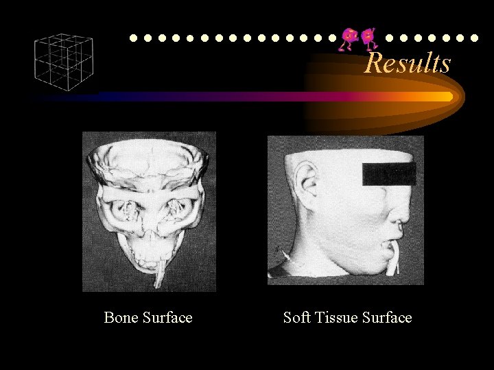 ●●●●●●●●●●●●● Results Bone Surface Soft Tissue Surface ●●●●●●●●●●●●● Results Bone Surface Soft Tissue Surface