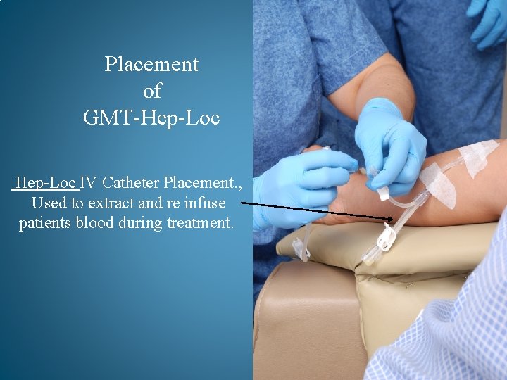 Placement of GMT-Hep-Loc IV Catheter Placement. , Used to extract and re infuse patients