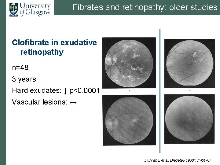 Fibrates and retinopathy: older studies Clofibrate in exudative retinopathy n=48 3 years Hard exudates: