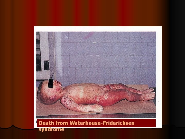 Death from Waterhouse-Friderichsen syndrome Death from Waterhouse-Friderichsen syndrome