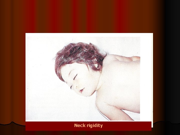 Neck rigidity Neck rigidity
