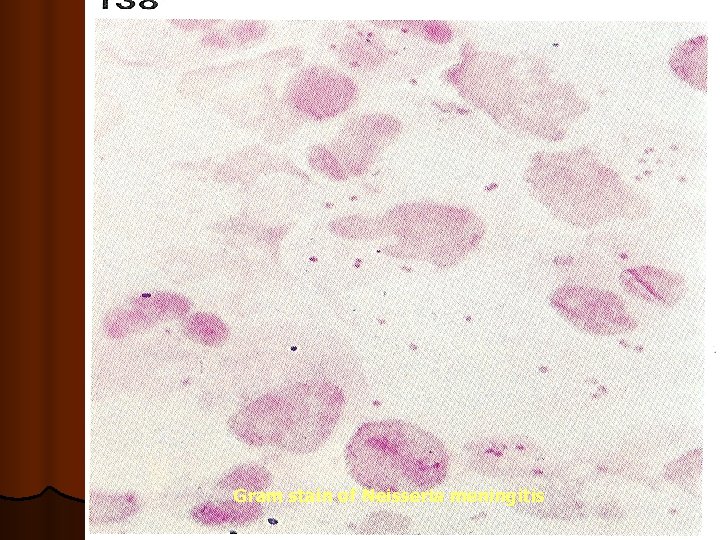Gram stain of Neisseria meningitis Gram stain of Neisseria meningitis