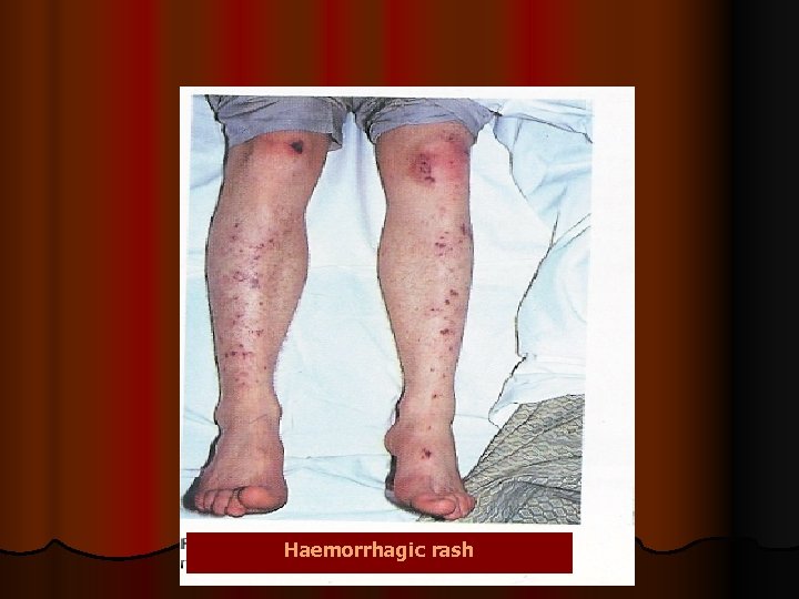 Haemorrhagic rash Haemorrhagic rash