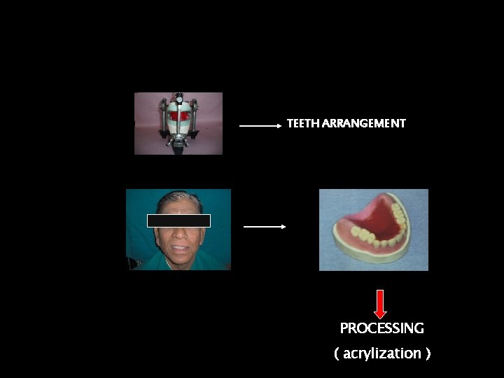TEETH ARRANGEMENT PROCESSING ( acrylization ) 