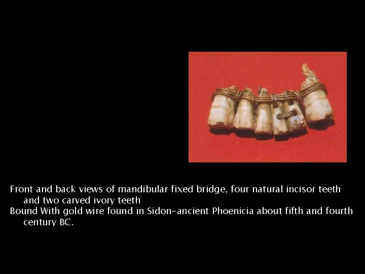 Front and back views of mandibular fixed bridge, four natural incisor teeth and two