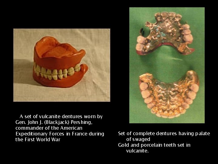A set of vulcanite dentures worn by Gen. John J. (Blackjack) Pershing, commander of